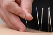 Acupuncture