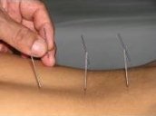 Acupuncture